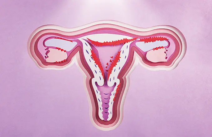 O Que é Endometriose Profunda